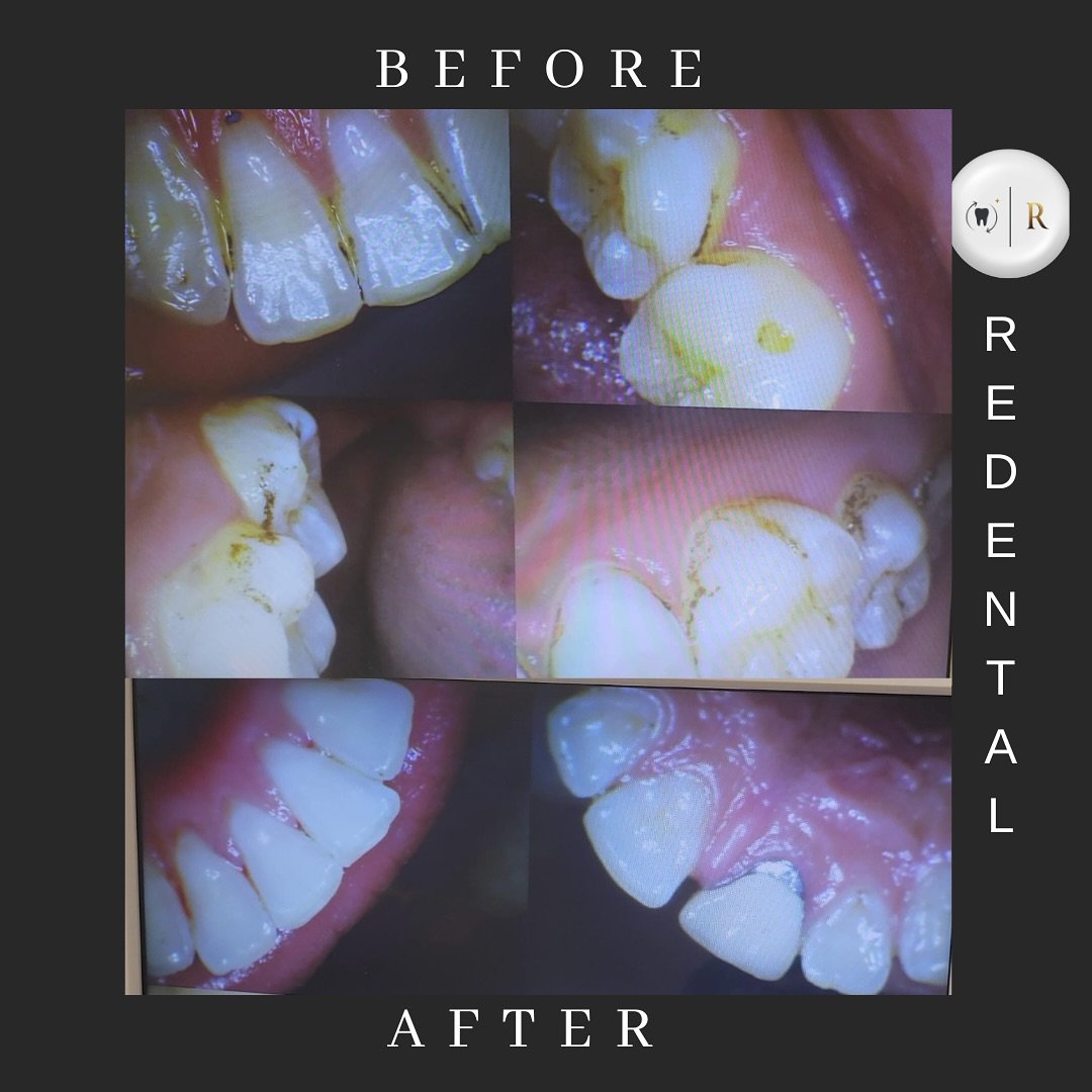 🦷 “Cleaning your teeth doesn’t weaken them — it protects them!”
Regular scaling removes stubborn plaque, food debris & bacteria that your brush can’t reach.
Think of it as a deep cleanse, not damage! ✨
Don’t let myths stop you from keeping your smile healthy.
✅ Safe
✅ Painless
✅ Essential every 6 months
#DentalFacts #ToothCleaningMyth #ScalingIsSafe #OralHealthMatters #ReDentalSmiles #redentalindia