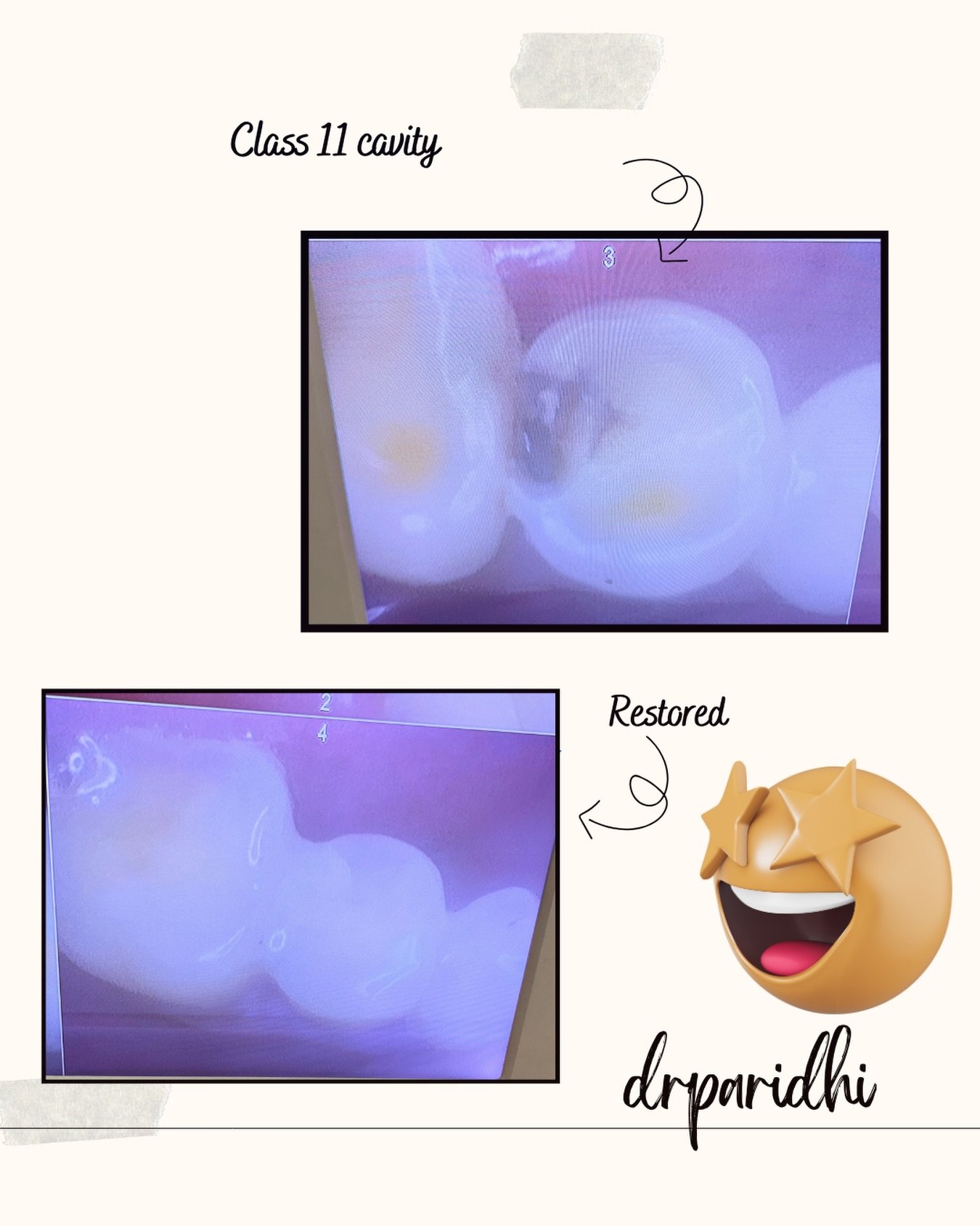 What may seem small from the outside, is huge inside.
Don’t ignore those cavities just coz its not hurting…😪
.
#redentalclinic #redentalindia #restorative #dentalhygiene #dentalcare #oralcare #oralhygiene #mouthcare #mouthhygiene #gumcare #badbreath #dentalgram #dentistgram #dentistsofinsta #dentistsofinida #india #preventivehealthcare #dental