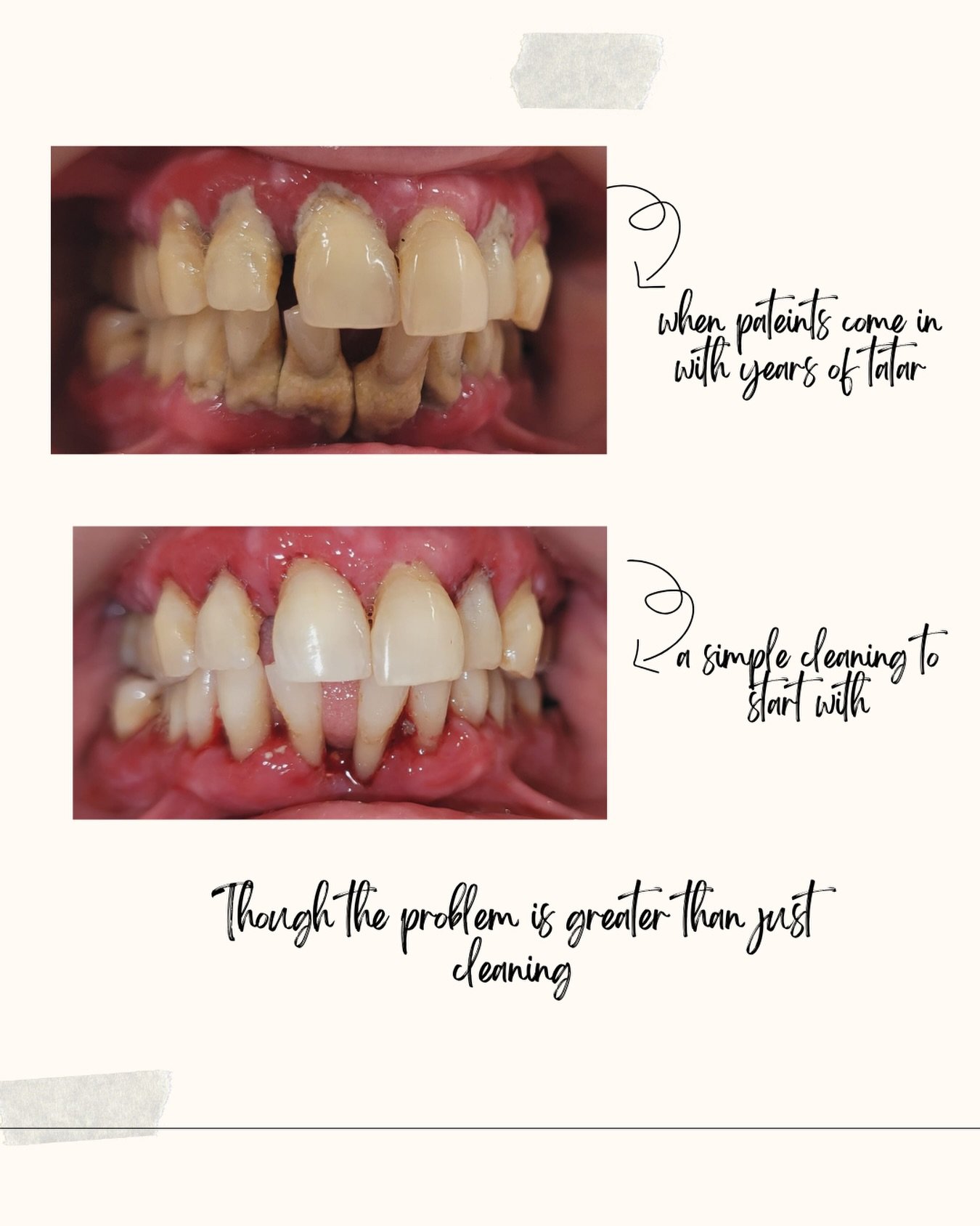 A single cleaning can improve your gum health instantly — but regular check-ups keep your smile safe for life.
A healthy mouth is built on consistency, not emergency visits 🤍
Book your routine dental cleaning today.

#ReDental #PreventiveDentistry #scaling #dentalhygiene #dentalcare #oralcare #oralhygiene #mouthcare #mouthhygiene #gumcare #badbreath #dentalgram #dentistgram #dentistsofinsta #dentistsofinida #india #preventivehealthcare #dental