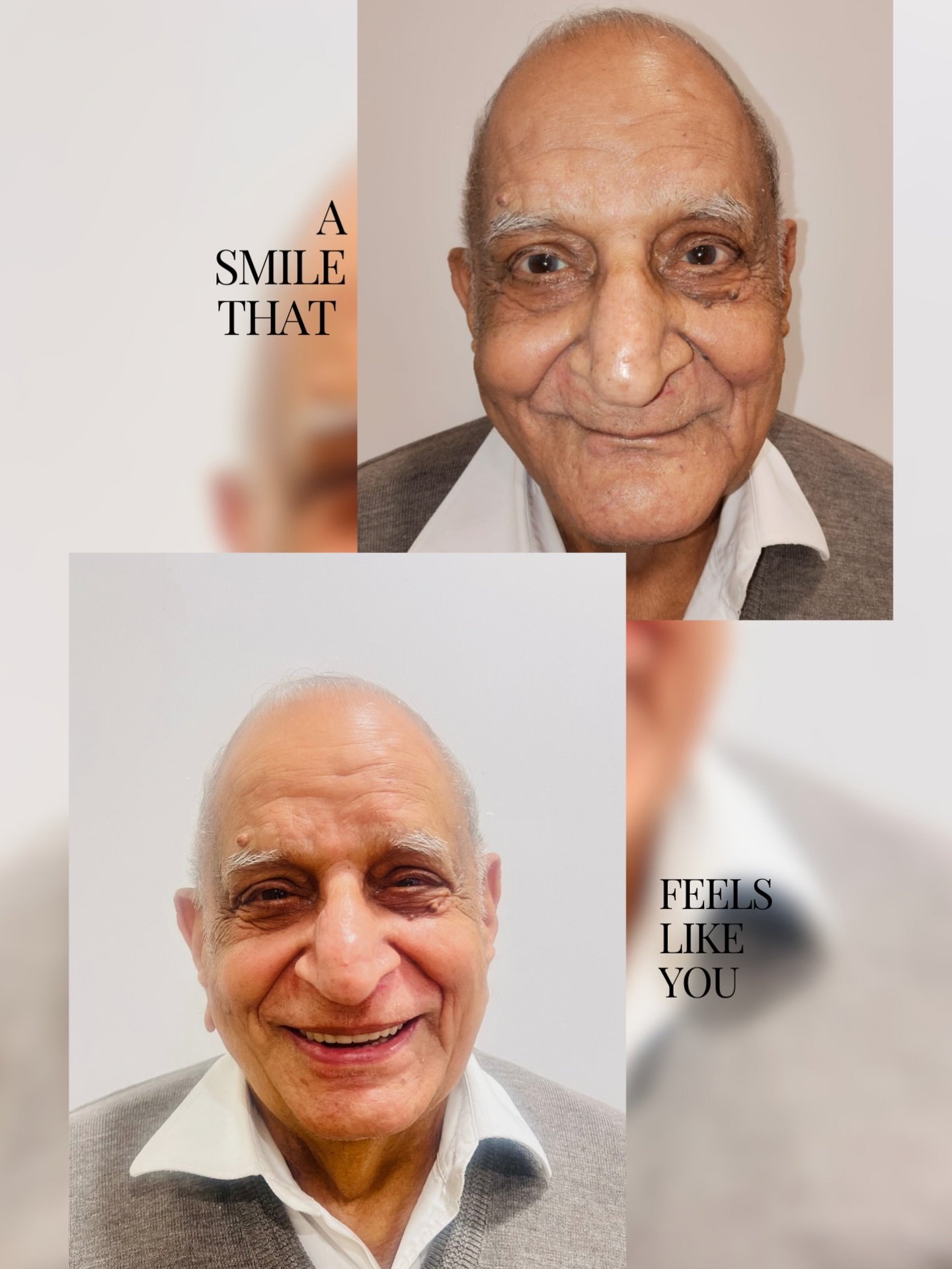 Grateful for Mr Chibber, a mathematician for his calm aura and quiet strength. The light he brought into the room made the entire procedure a beautiful experience for us as doctors. It was our privilege to support him with care, precision, and empathy — working together to create a smile that feels confident, comfortable, and truly his.